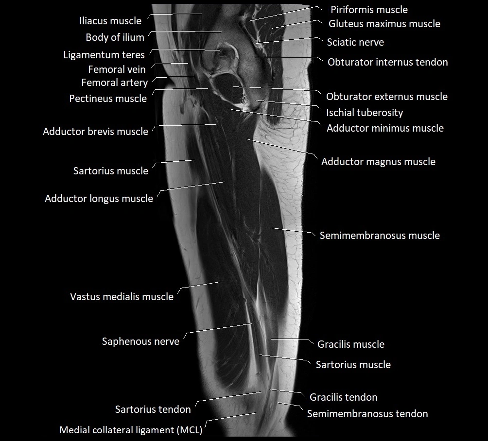 Thigh sagittal cross sectional anatomy MRI 3T image 15.webp